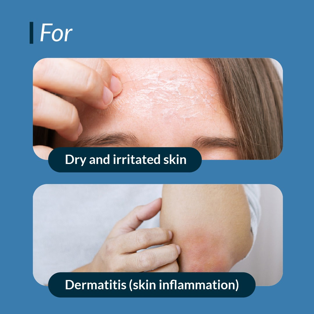 irritated skin and dermatitis (skin inflammation) treated by Duramoist Hydro-Boost Moisturizer.