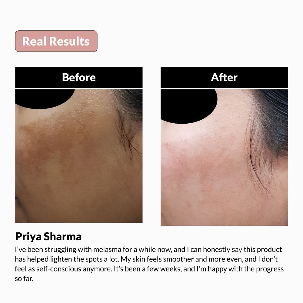 How-to-treat-melasma-at-home-melaclin
