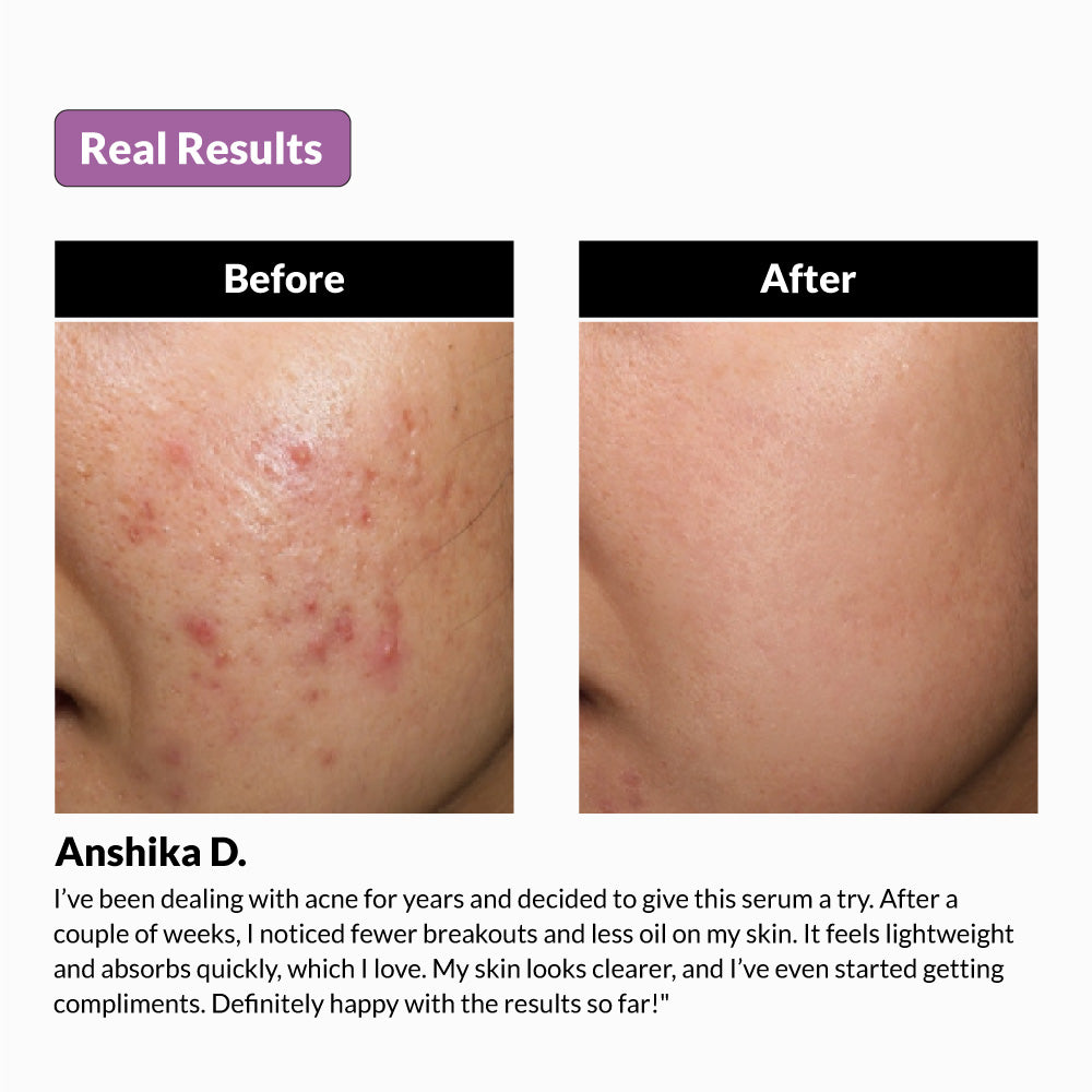 Acnomix Serum Buy Acnosome Face Serum Online | Niacinamide, Salicylic Acid | 30ml ...